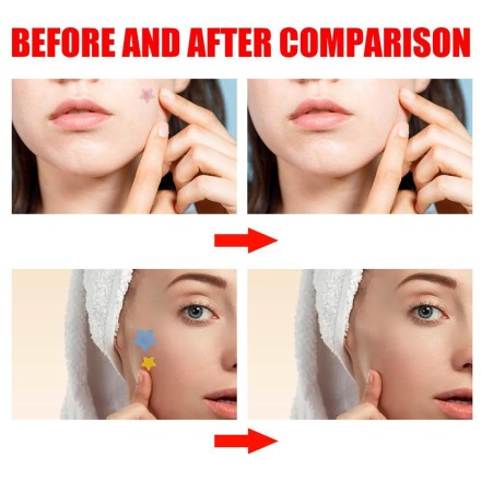 Патч гідрогелевий Pipmples Acne Skin Tag Patches проти вугрів, акне, прищів, бородавок і запалень 200 шт./1 уп