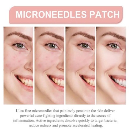 Патч гідрогелевий The Look Of Comedo Acne Skin Tag Patches від вугрів, акне, прищів, бородавок, комедон 72 шт.